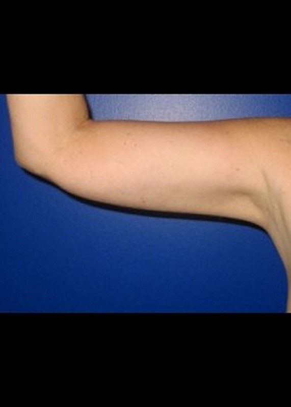 Liposuction before and after - after