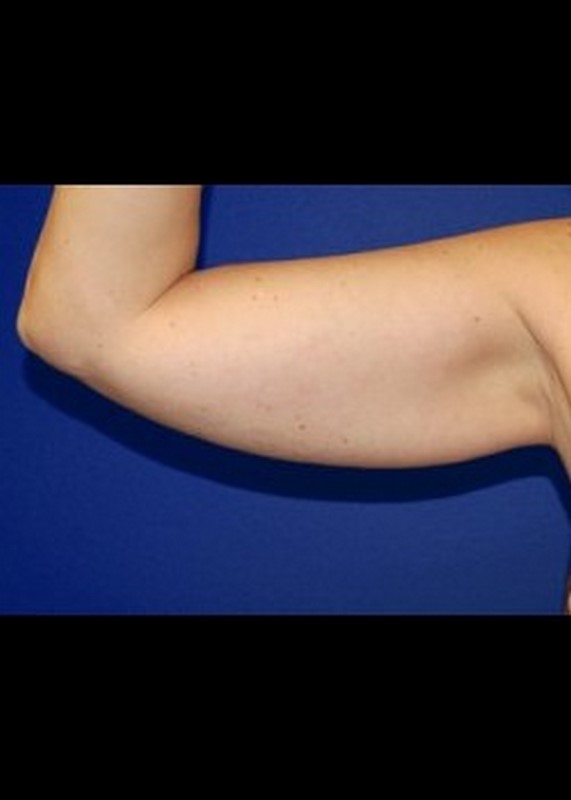 Liposuction before and after - before