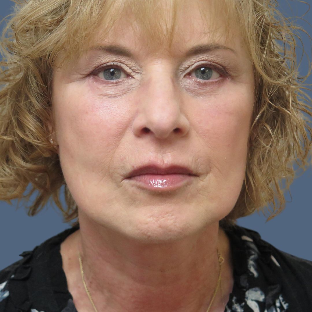 Facelift before and after - after