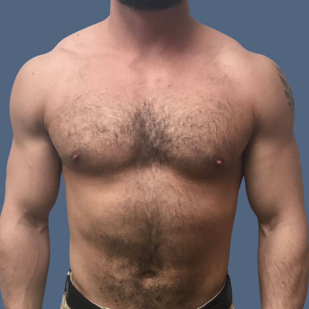 Breast Reduction before and after - after
