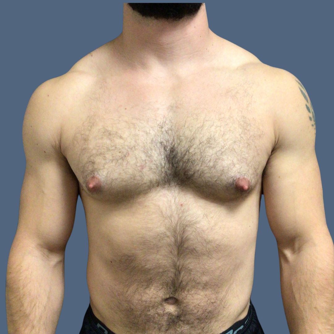 Breast Reduction before and after - before