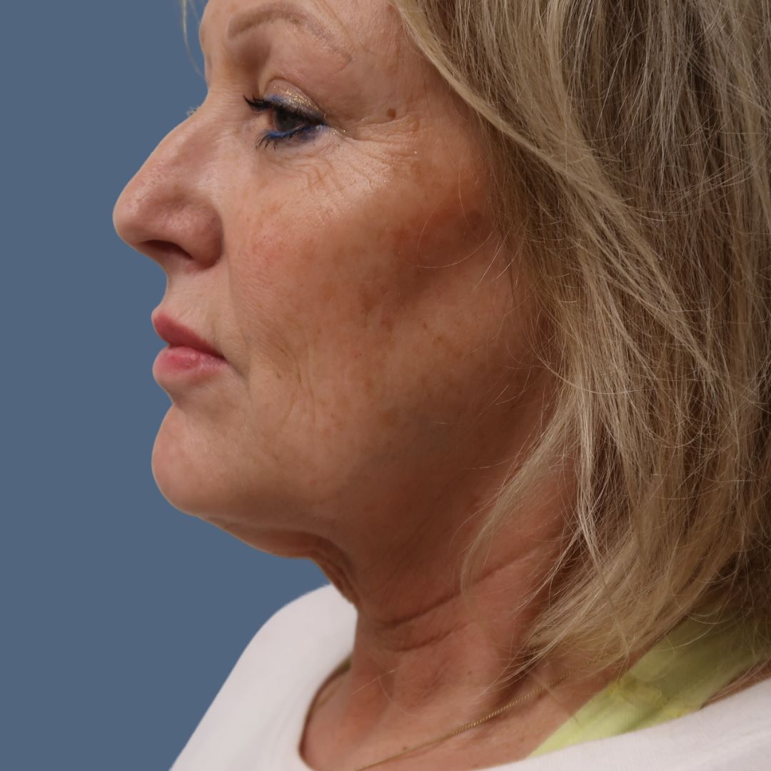 Facelift before and after - before