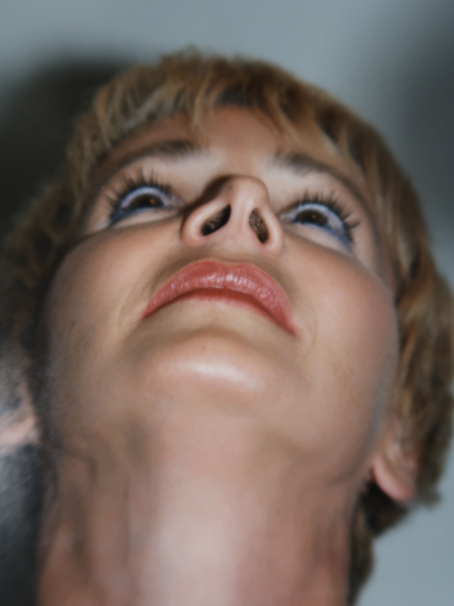 Chin before and after - after