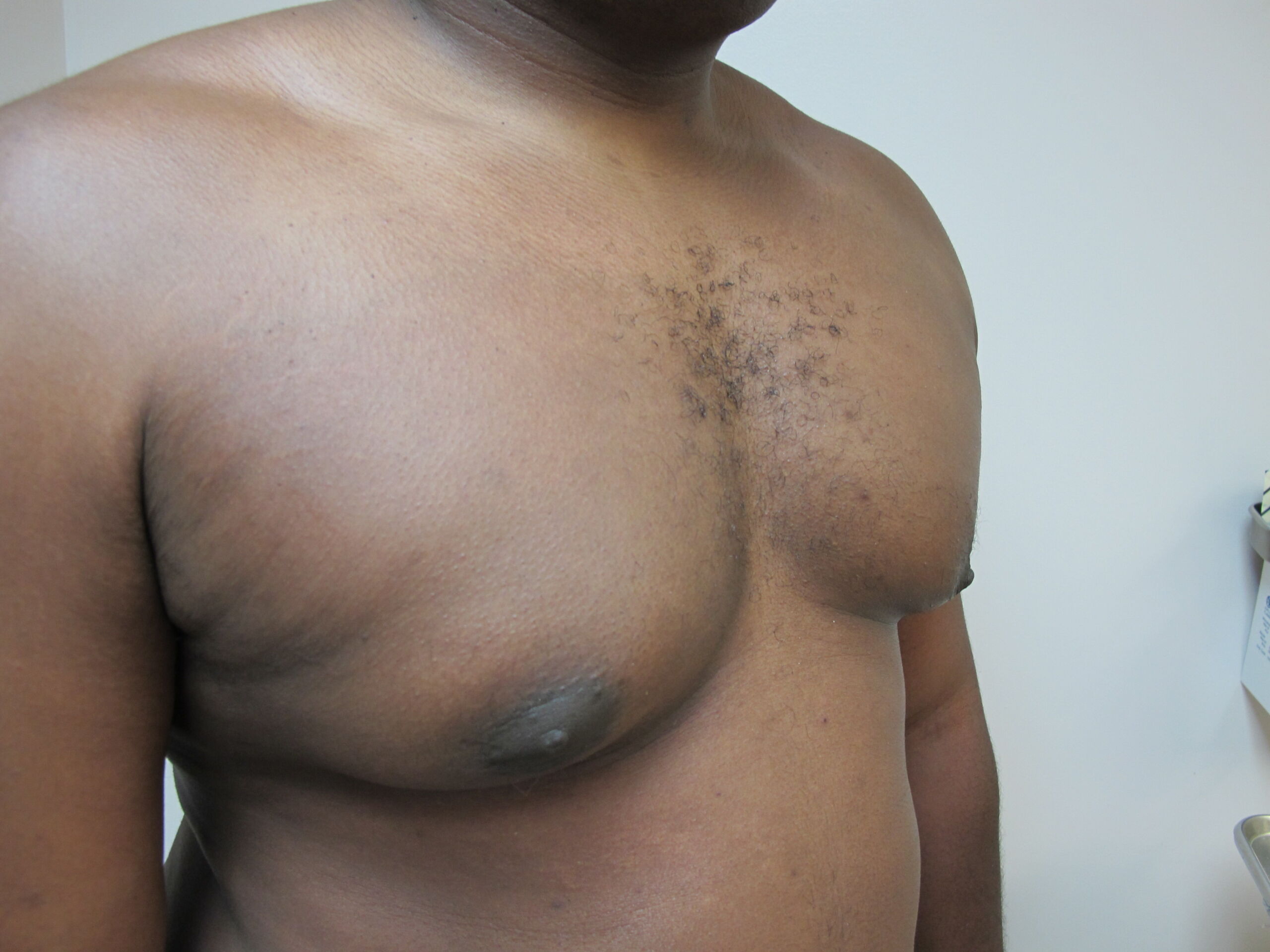 Breast Reduction before and after - after