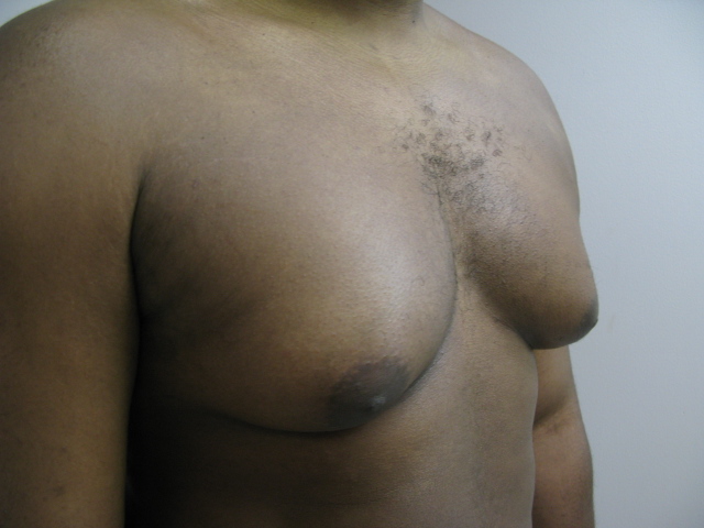 Breast Reduction before and after - before