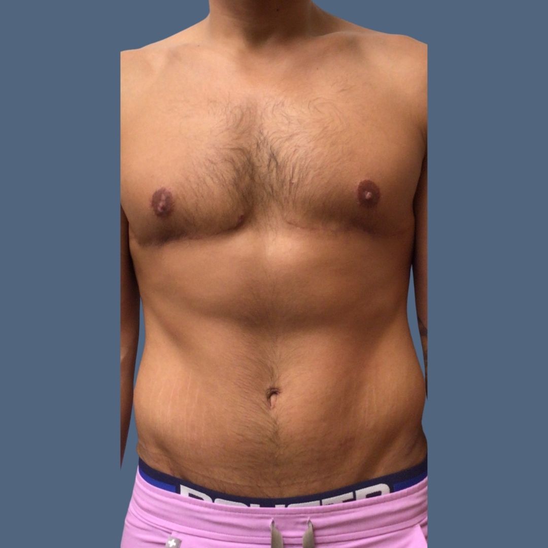 Breast Reduction before and after - after