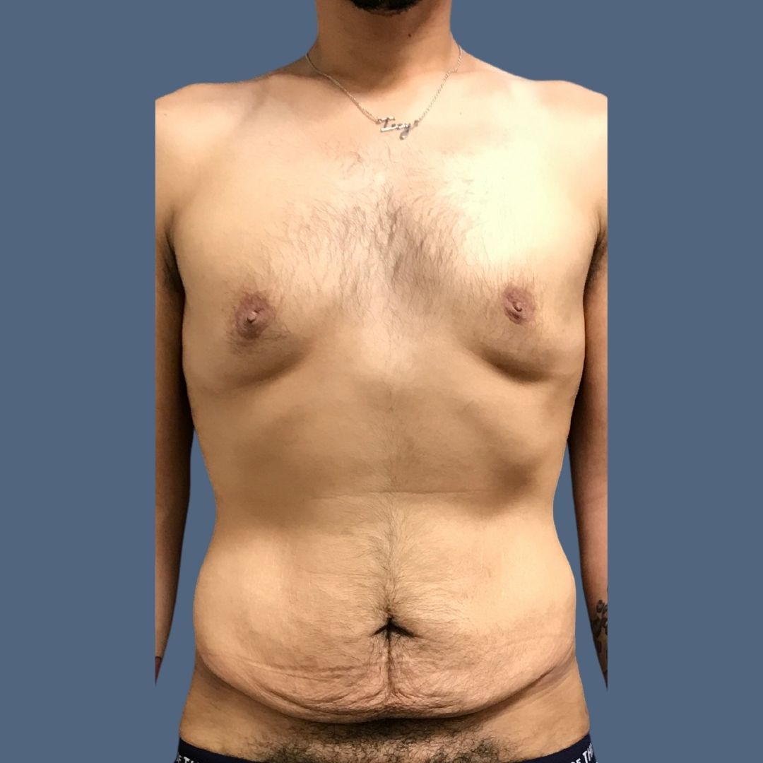 Breast Reduction before and after - before