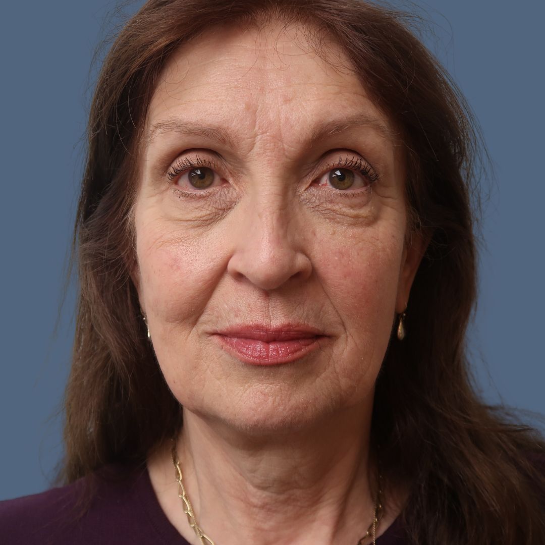 Facelift before and after - before