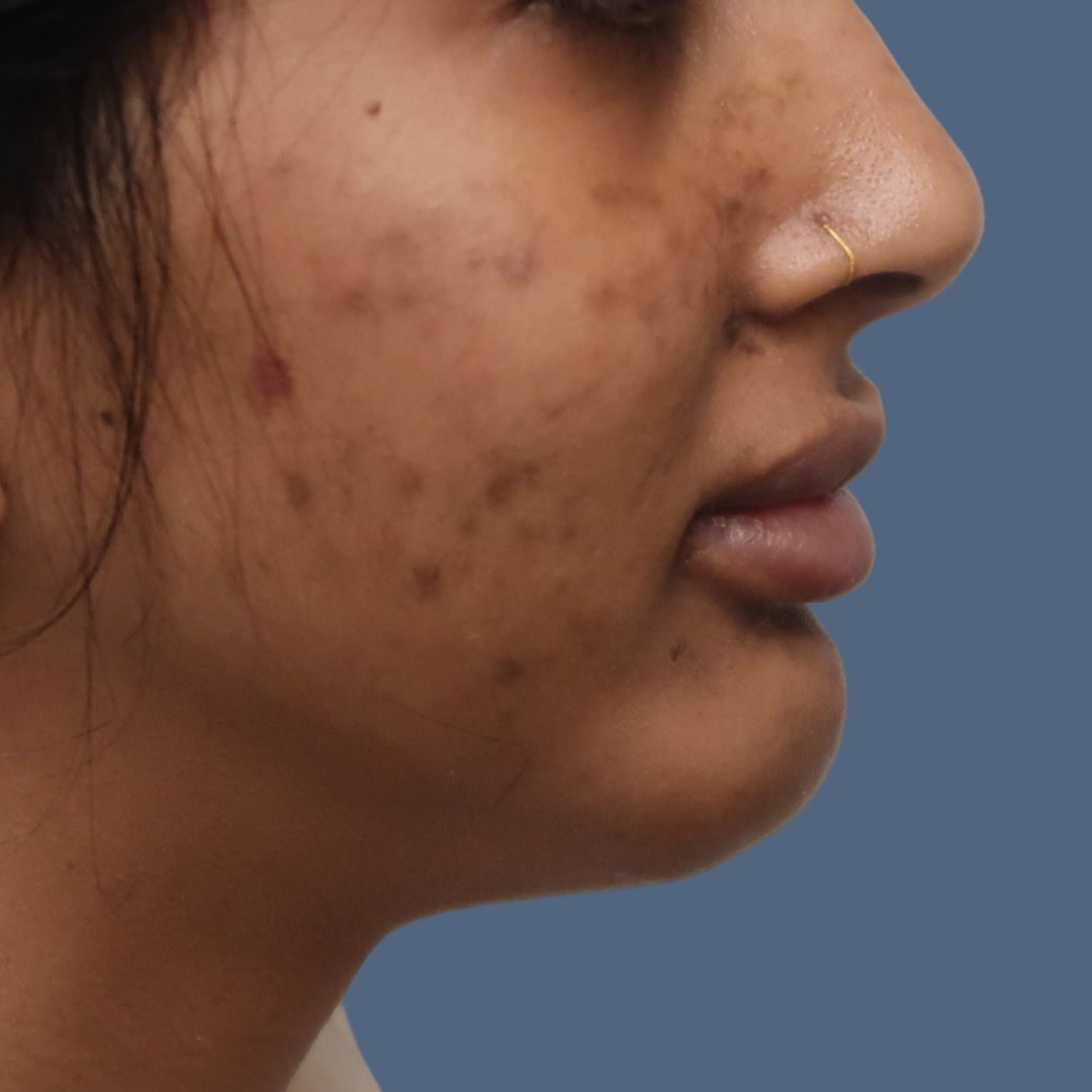 Chin before and after - after