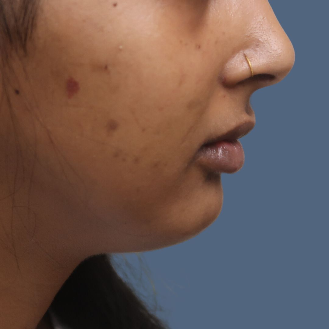 Chin before and after - before