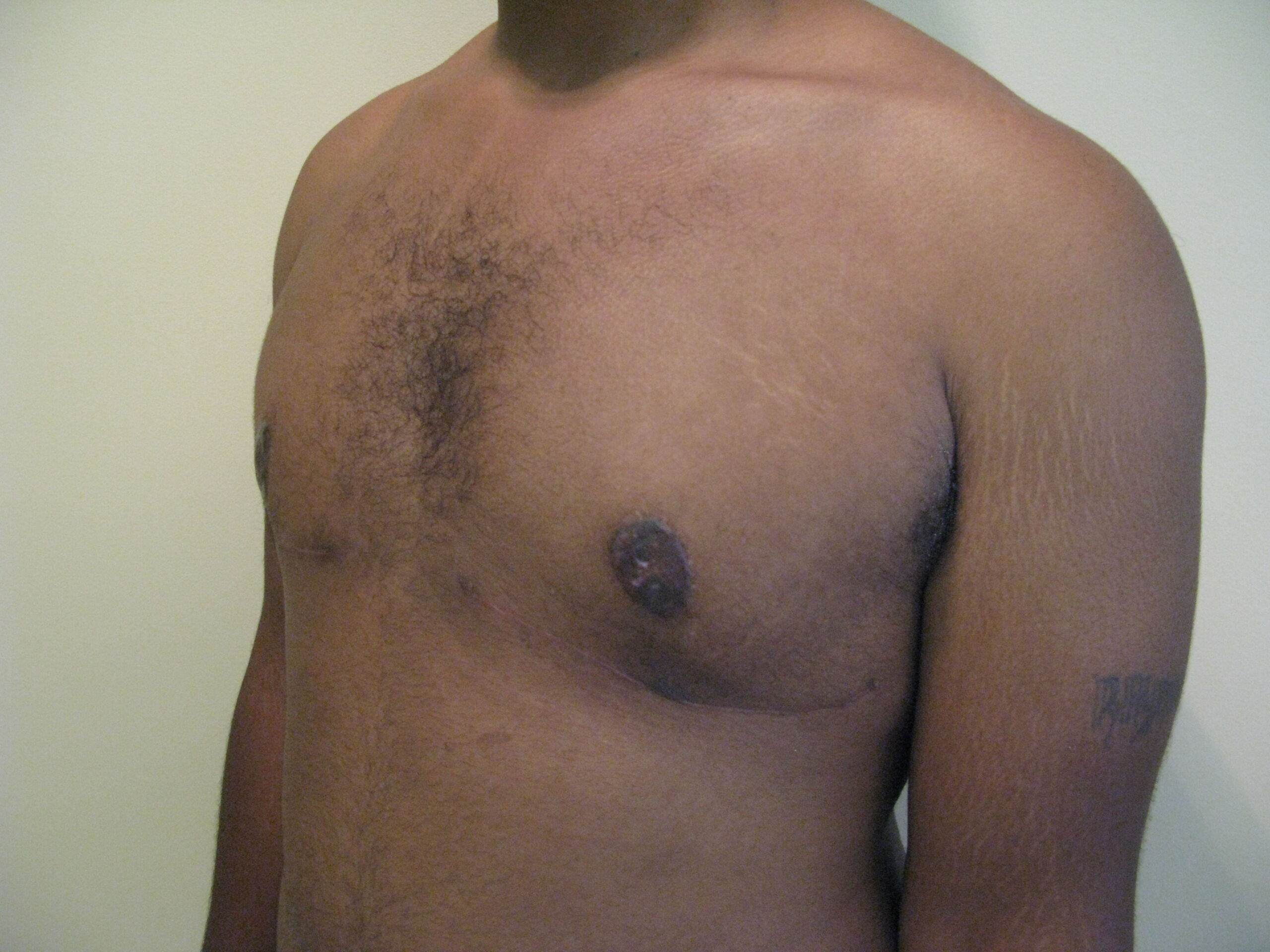 Breast Reduction before and after - after