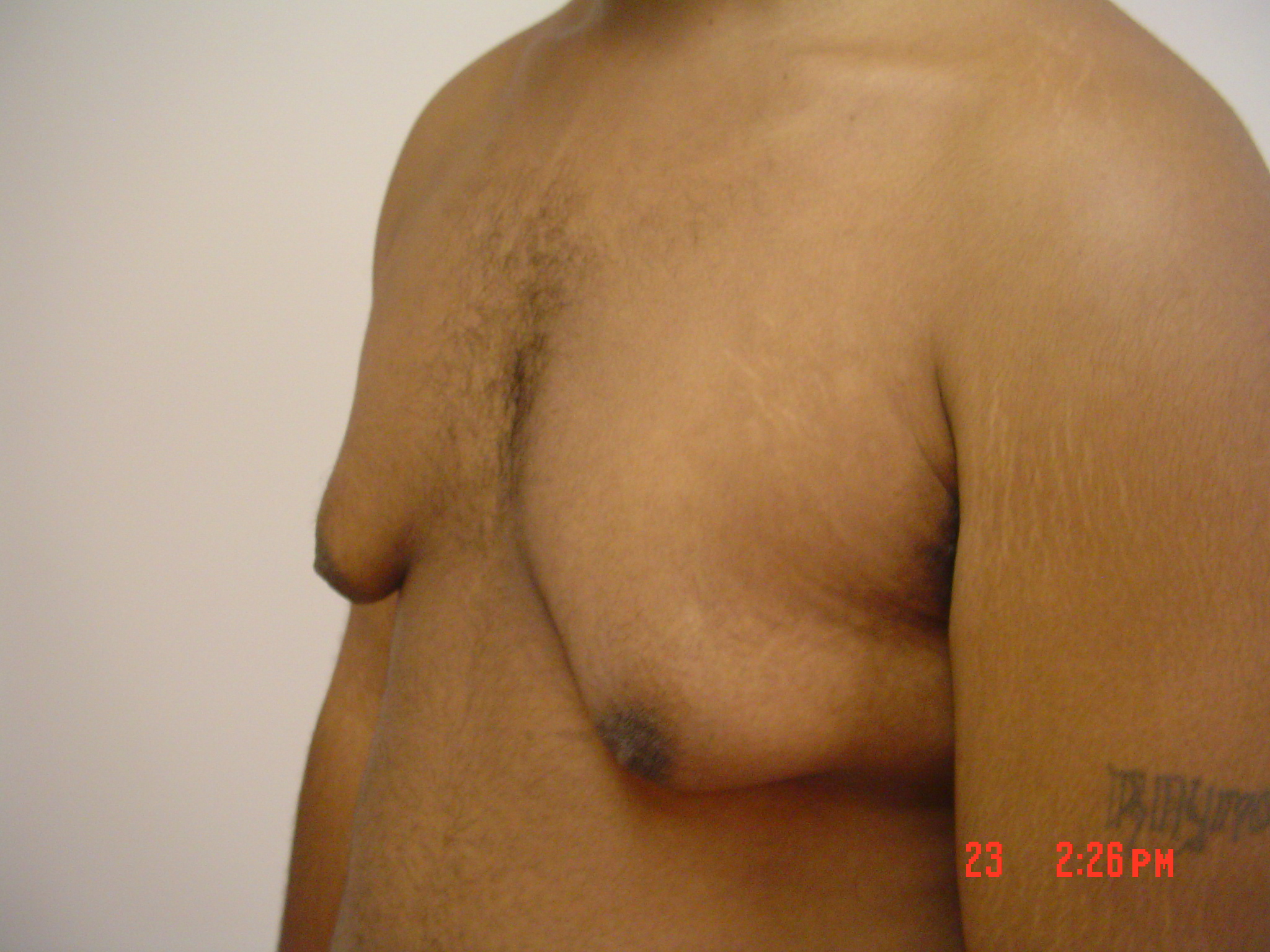Breast Reduction before and after - before
