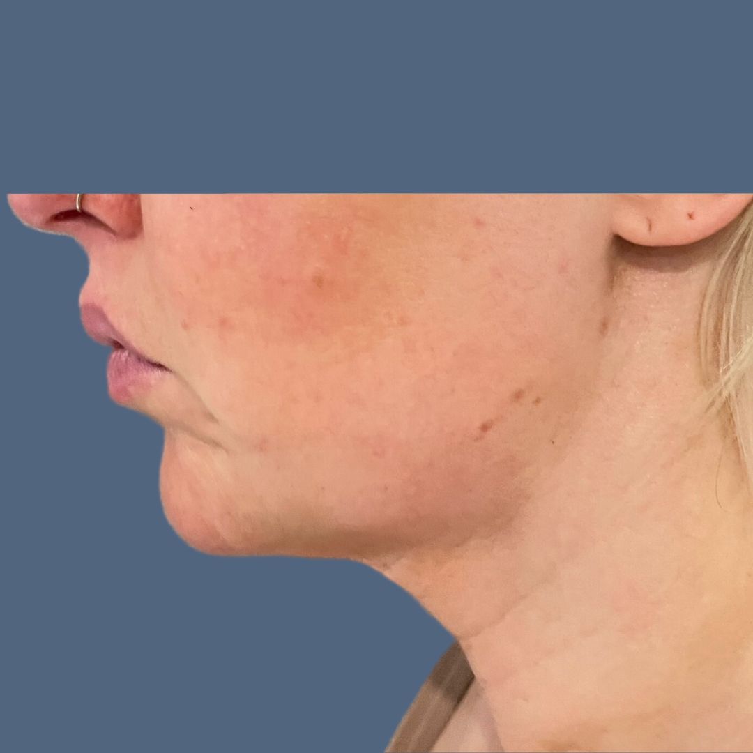 Liposuction before and after - after