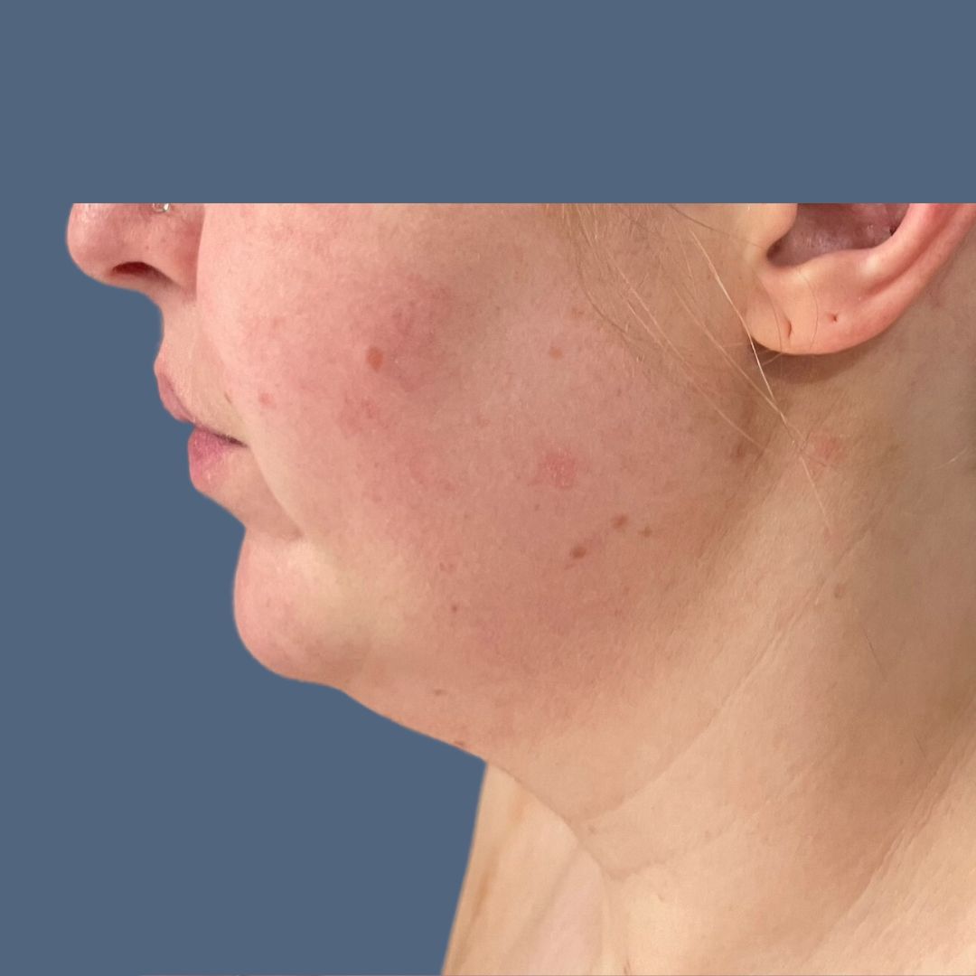 Liposuction before and after - before