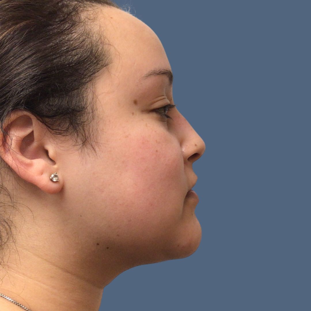 Liposuction before and after - after