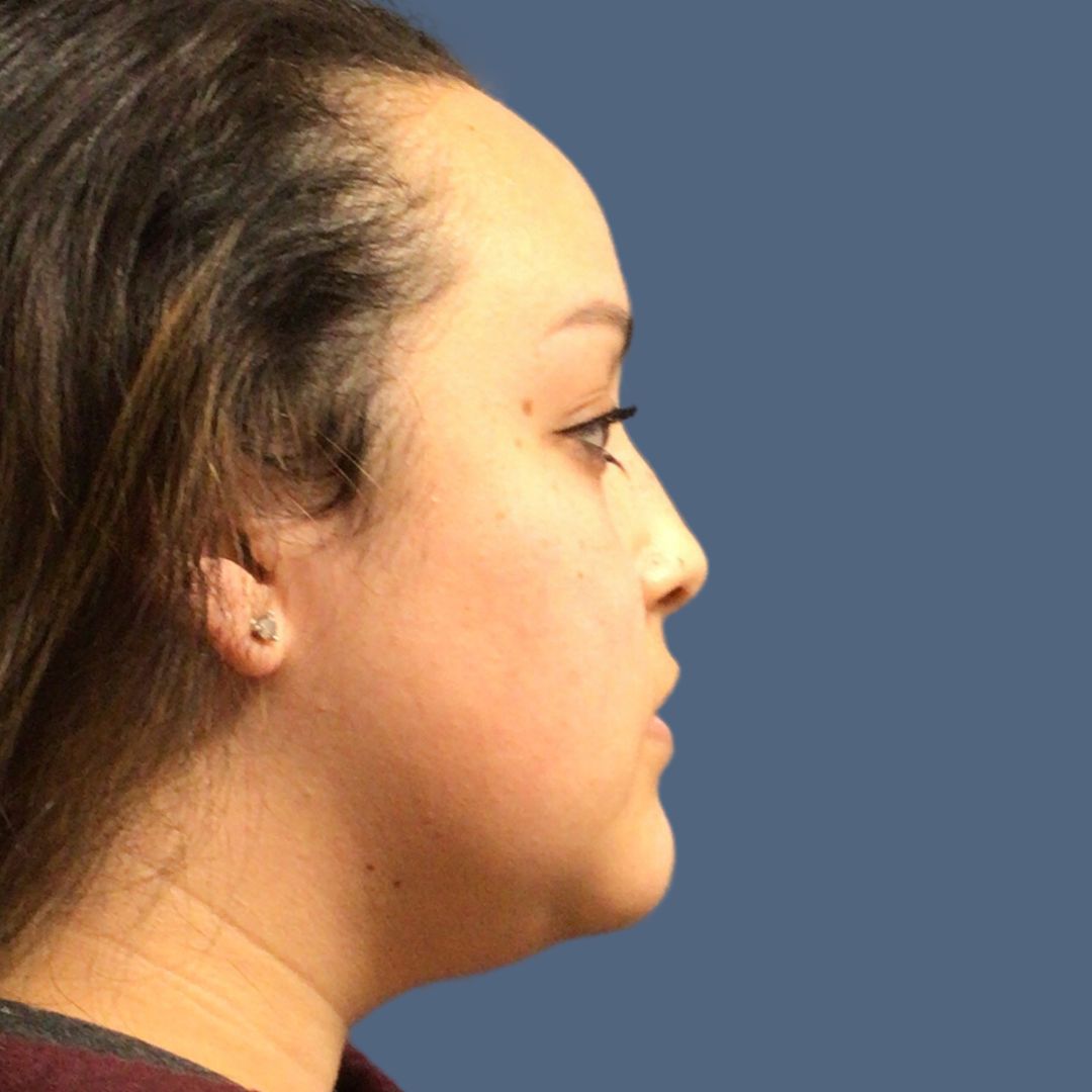 Liposuction before and after - before