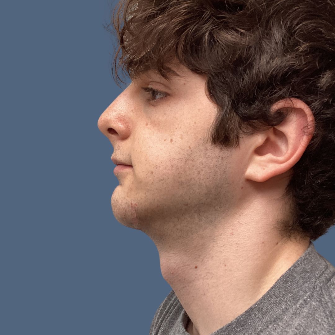 Chin before and after - after