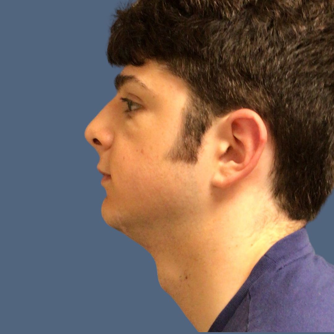 Chin before and after - before