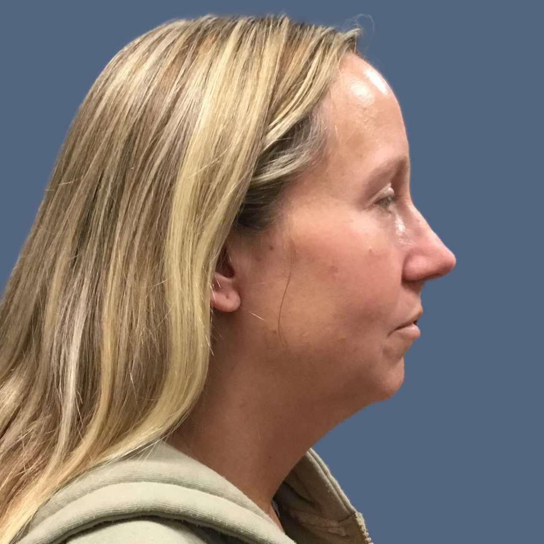 Liposuction before and after - before
