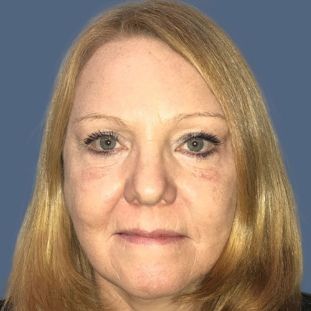 Facelift before and after - after