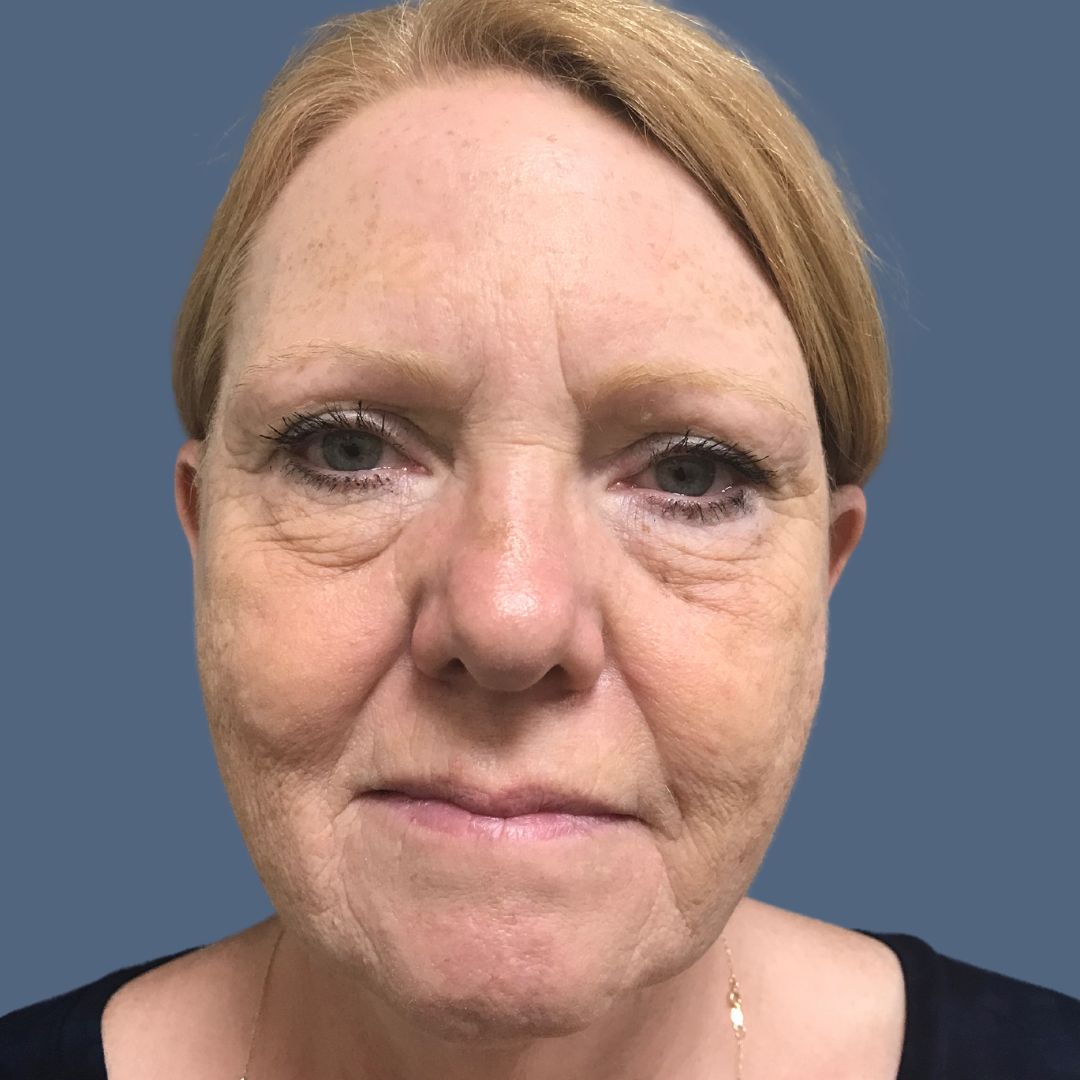 Facelift before and after - before