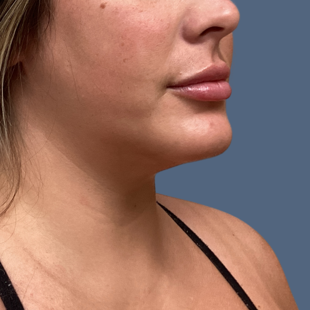 Liposuction before and after - after