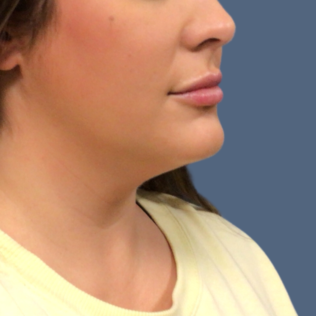 Liposuction before and after - before