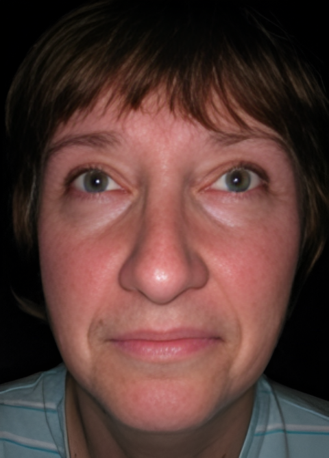 Procedure before and after - after