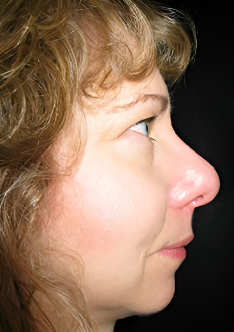 Procedure before and after - after