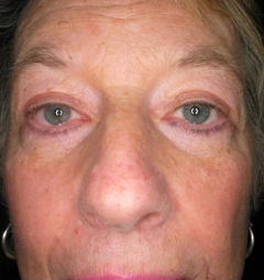 Blepharoplasty before and after - after