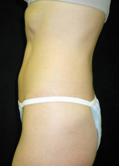 Procedure before and after - after