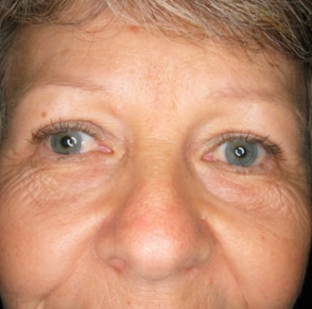 Blepharoplasty before and after - after