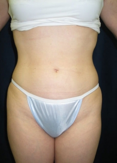 Procedure before and after - after