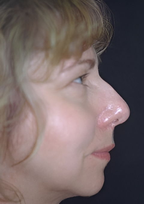 Procedure before and after - before