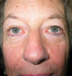 Blepharoplasty before and after - before