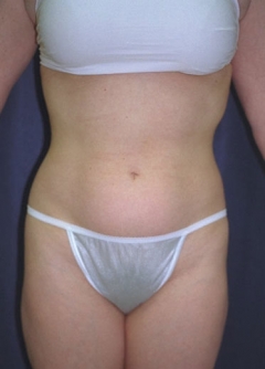 Procedure before and after - before