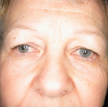 Blepharoplasty before and after - before