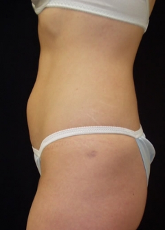 Procedure before and after - before