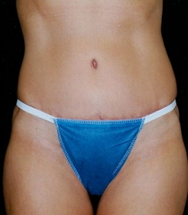 Tummy Tuck before and after - after