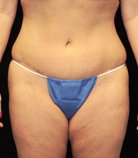 Tummy Tuck before and after - after
