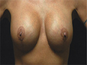 Procedure before and after - after