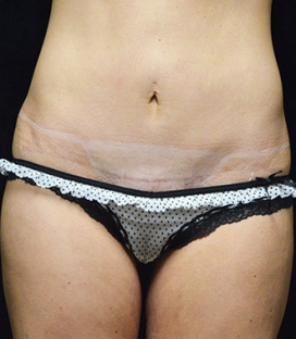 Tummy Tuck before and after - after