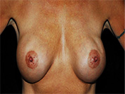 Procedure before and after - before