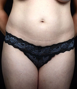 Tummy Tuck before and after - before