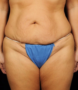 Tummy Tuck before and after - before