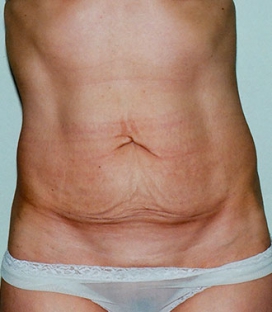 Tummy Tuck before and after - before