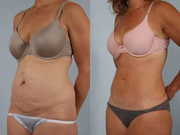 Tummy Tuck before and after - after