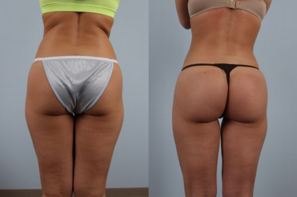 Liposuction before and after - after