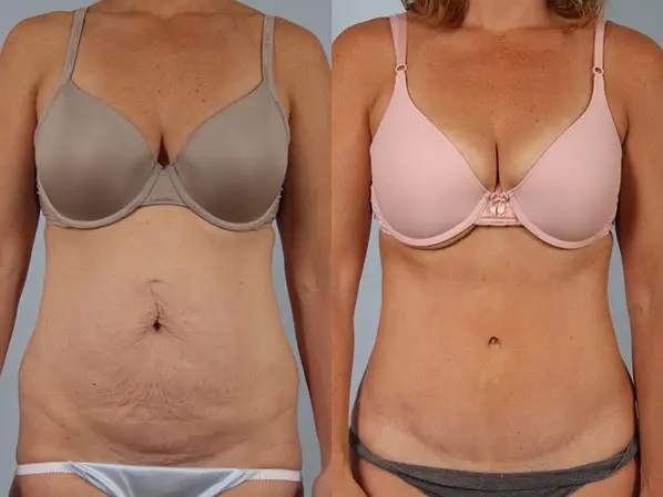 Tummy Tuck before and after - after
