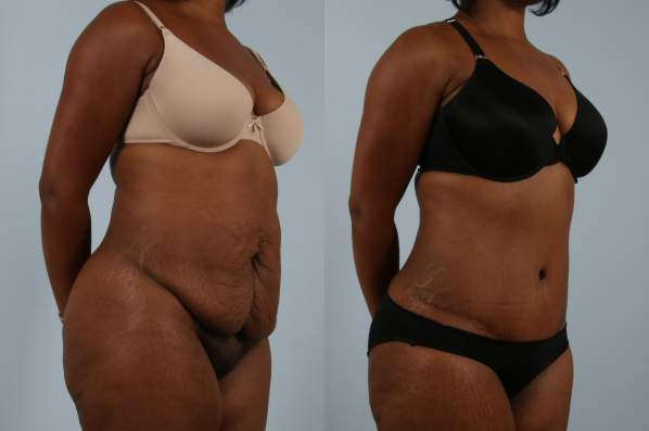Tummy Tuck before and after - after